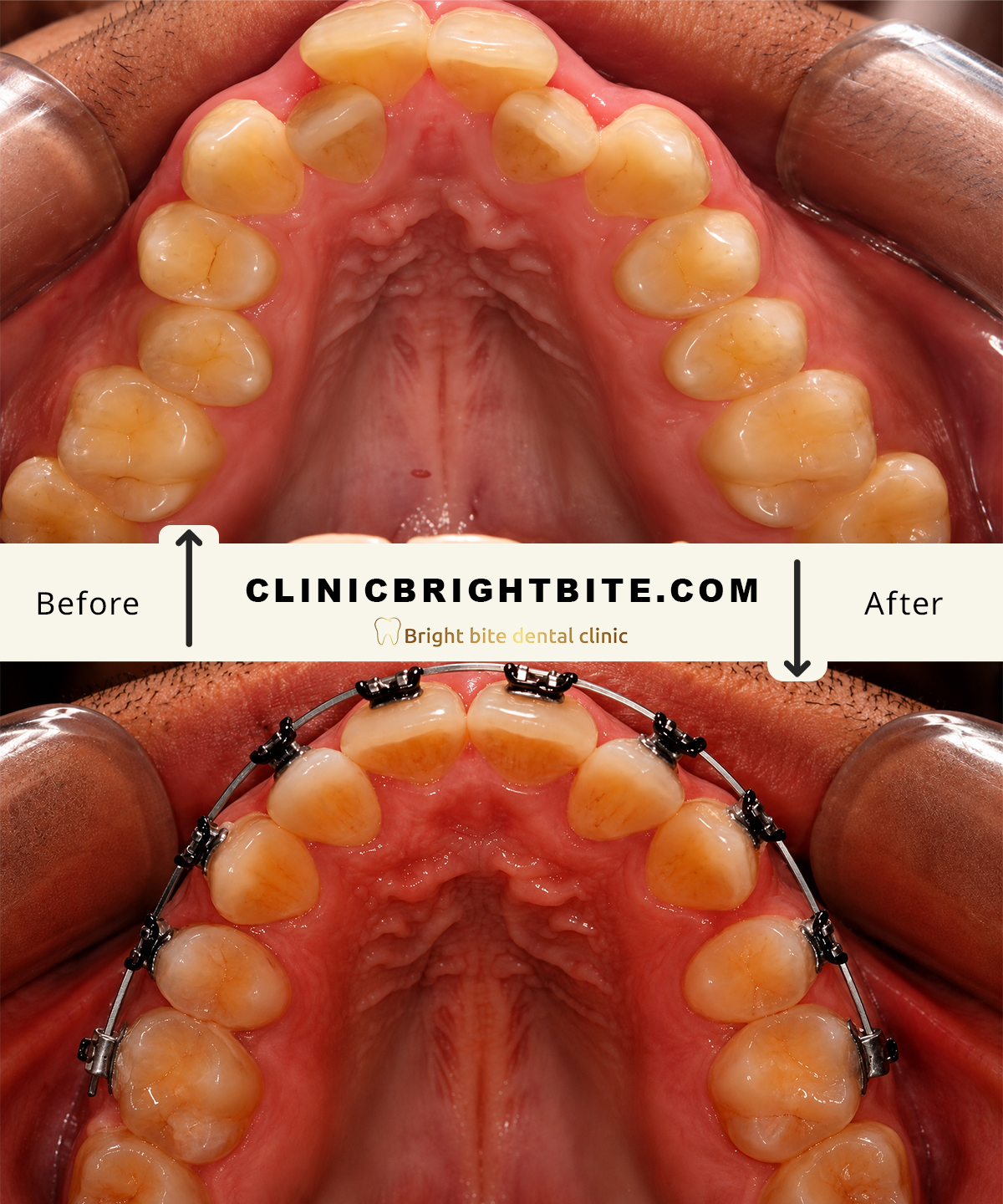 Orthodontic treatment