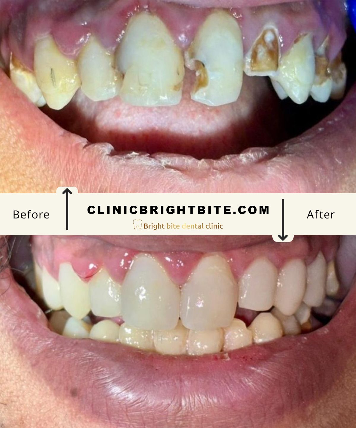 Veneers