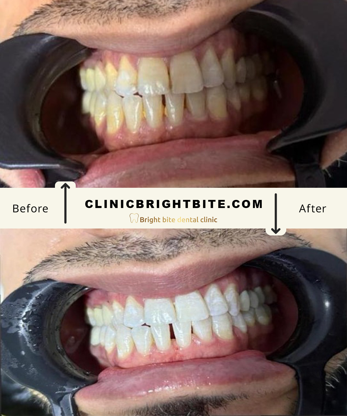 Professional whitening